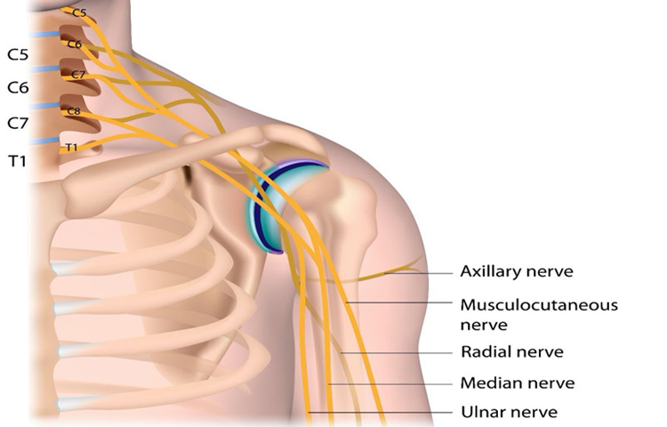 Liệt đám rối thần kinh cánh tay (liệt chi trên) là gì? Chẩn đoán và các phương pháp điều trị